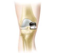 best knee replacement surgeon in Chandigarh