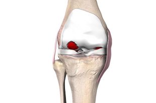 FT-3D knee resurfacing cost in India