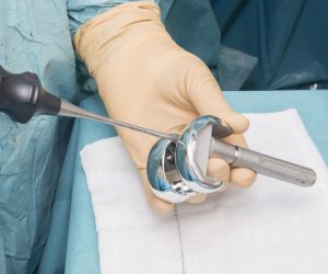 Knee replacement surgery in Delhi