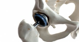 best hip replacement surgery in Chandigarh