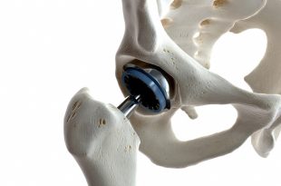 best hip replacement surgery in Chandigarh