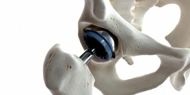 best hip replacement surgery in Chandigarh