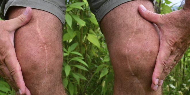 best knee replacement surgeon in Chandigarh