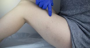 Varicose veins treatment in Chandigarh