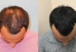 Best hair transplant in chandigarh