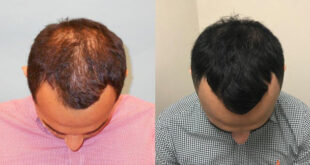 Best hair transplant in chandigarh