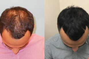 Best hair transplant in chandigarh