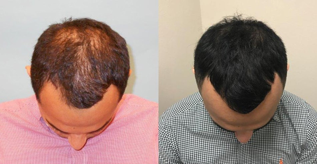 Best hair transplant in chandigarh