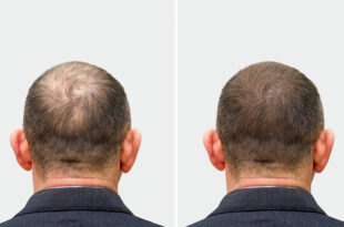 Best Hair Transplant in Chandigarh