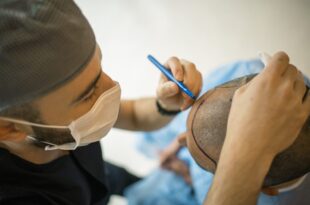 Hair Transplant in Chandigarh