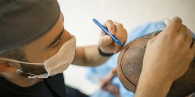Hair Transplant in Chandigarh