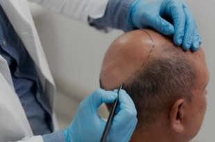 best hair transplant in Chandigarh