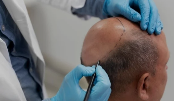 best hair transplant in Chandigarh