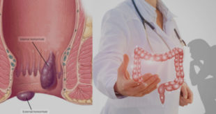 best piles clinic in Zirakpur