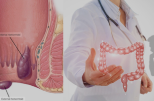 best piles clinic in Zirakpur