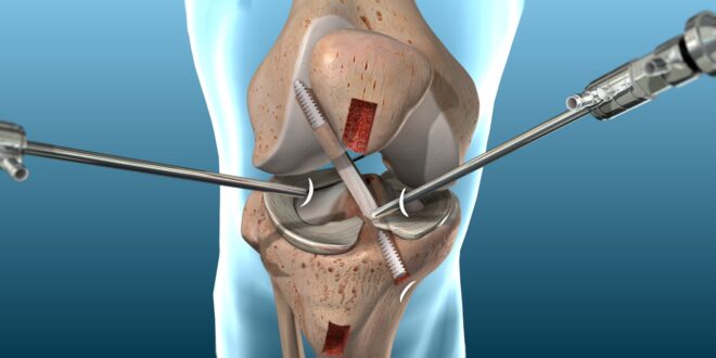 ACL surgery in Goa