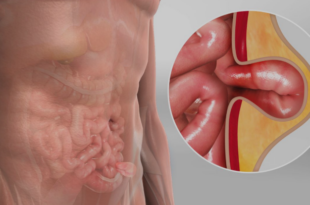 lap hernia specialist chandigarh