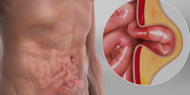 lap hernia specialist chandigarh