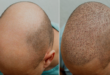 best hair transplant in Chandigarh