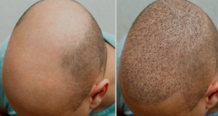 best hair transplant in Chandigarh
