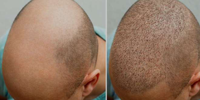 best hair transplant in Chandigarh