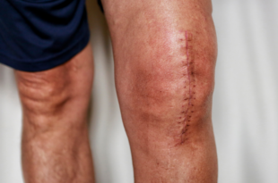 Sports surgery in Goa