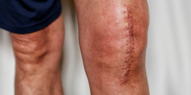 Sports surgery in Goa