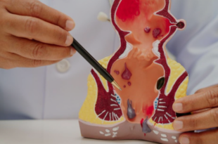 best piles treatment doctor in Panchkula