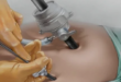 Laparoscopic surgery in Mumbai