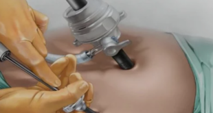 Laparoscopic surgery in Mumbai