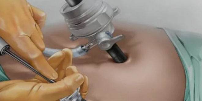 Laparoscopic surgery in Mumbai