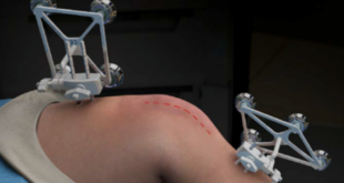 partial knee replacement in Goa