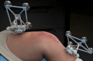 partial knee replacement in Goa