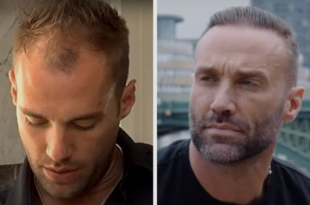 best hair transplant in Chandigarh