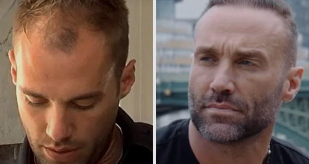 best hair transplant in Chandigarh