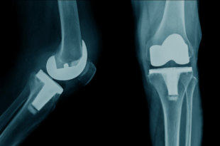 knee replacement surgery in Jaipur