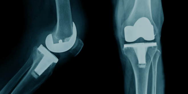 knee replacement surgery in Jaipur