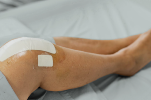 Knee Replacement Surgery in Lucknow