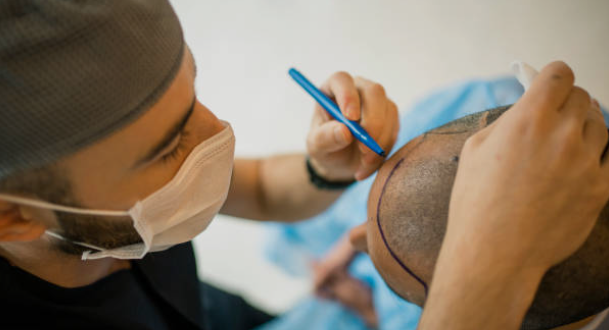 best hair transplant in Chandigarh Cost