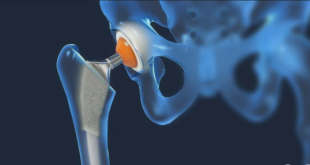 Hip Replacement Surgery in Chandigarh