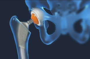 Hip Replacement Surgery in Chandigarh