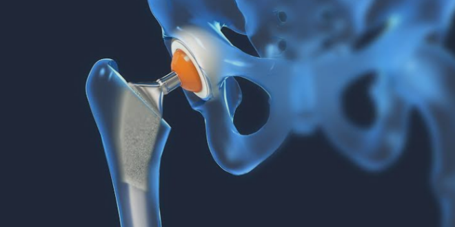 Hip Replacement Surgery in Chandigarh