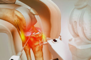 knee replacement surgery in Jaipur