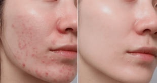 Laser Acne treatment in Mohali