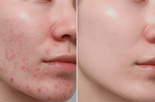 Laser Acne treatment in Mohali