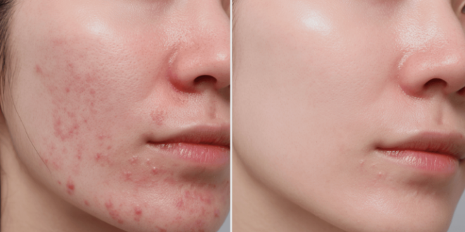 Laser Acne treatment in Mohali