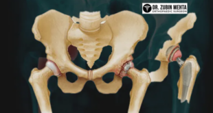 Hip Replacement Hospital in Chandigarh