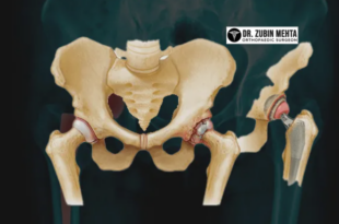 Hip Replacement Hospital in Chandigarh