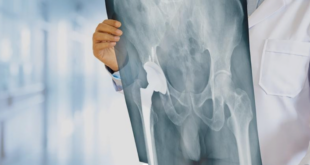 Hip replacement loosening treatment Chandigarh