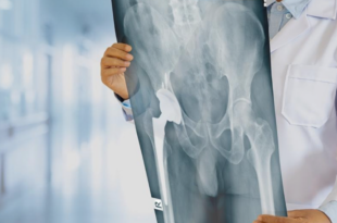 Hip replacement loosening treatment Chandigarh